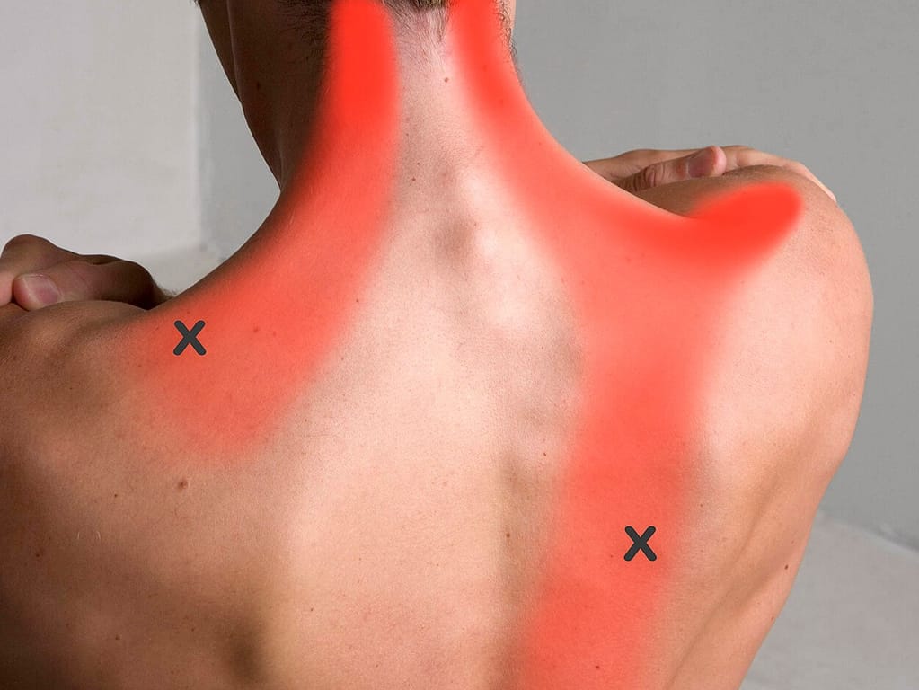 Cervikogénna bolesť hlavy spôsobená aktívnym trigger pointom krčnej chrbtice