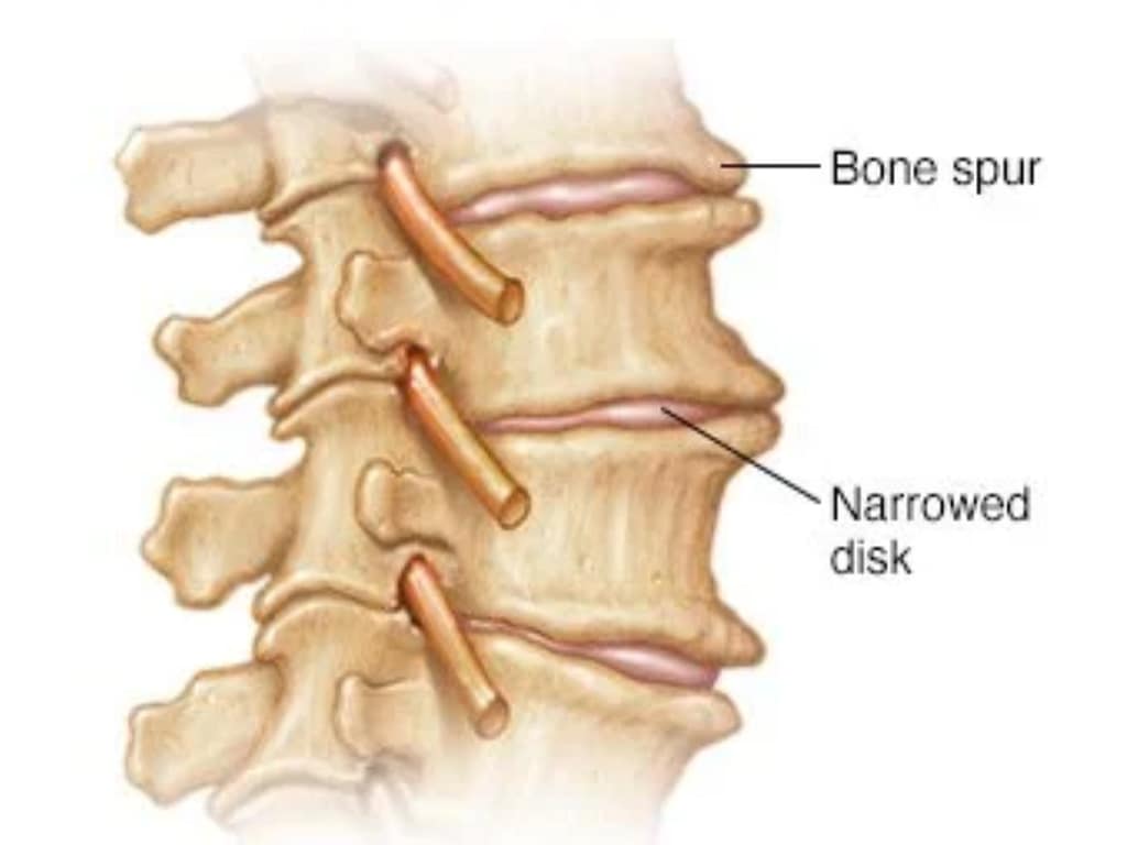 Osteoartritická chrbtica s osteofytmi a kompresiou platničky
