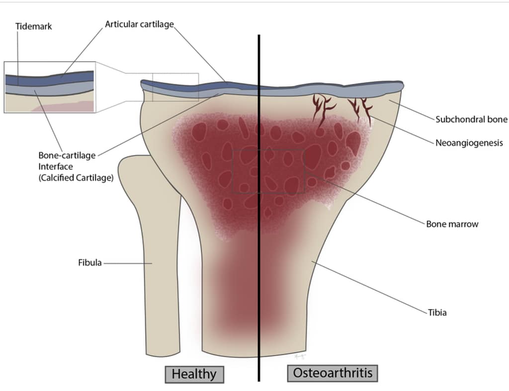 Porovnanie zdravého a osteoartritického kĺbu