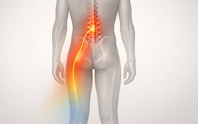 Vystreľujúca bolesť z platničky – hernia disku s radikulopatiou