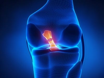 Poranenie predného skrížnehi väzu (ACL)