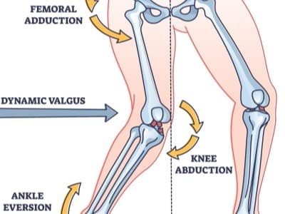 Mechanizmus nekontaktného poranenia ACL pri dopade a zmene smeru pohybu