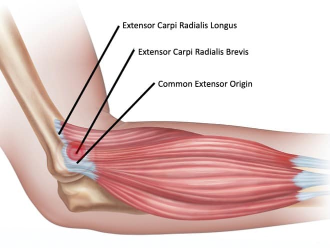 Tenisový lakeť - svaly, ktoré bolia