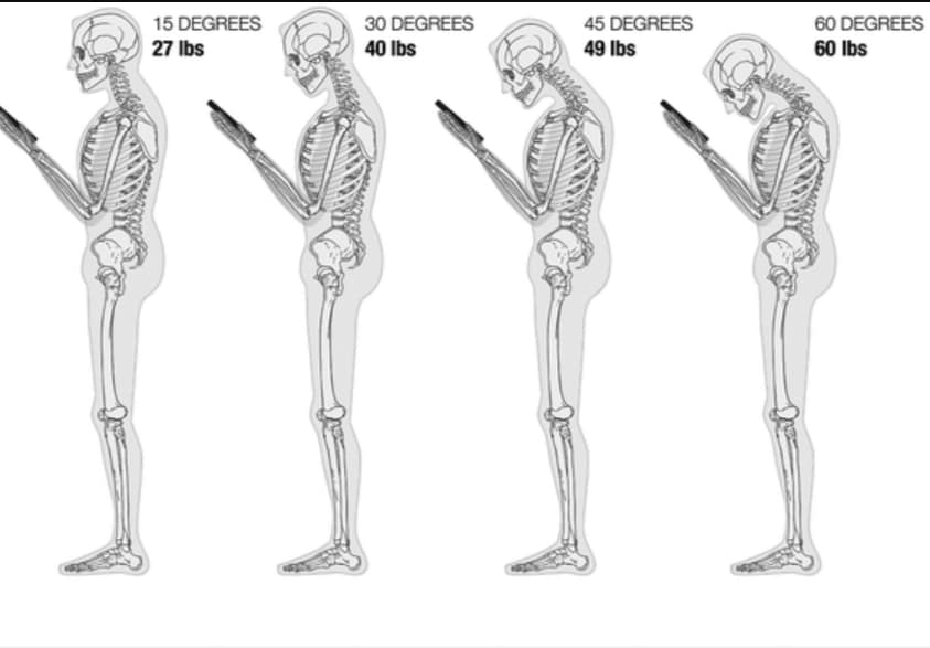 Zväčšujúci sklon chrbtice pôsobí významný tlak na štruktúry krku a môže vyvolať bolesť