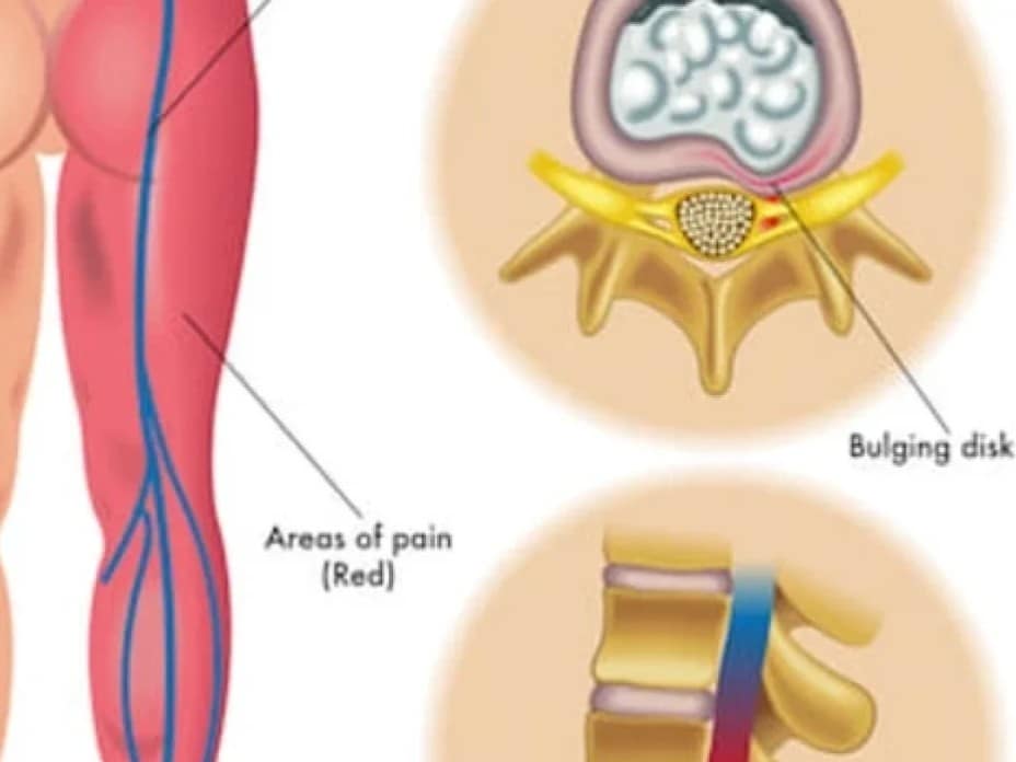 Vystreľujúcu bolesť do končatiny spôsobuje útlak nervu.